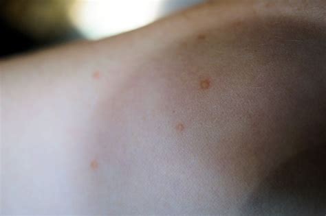 Cluster Of Blister Like Bumps Skin Cancer Forum 7252013 2087310