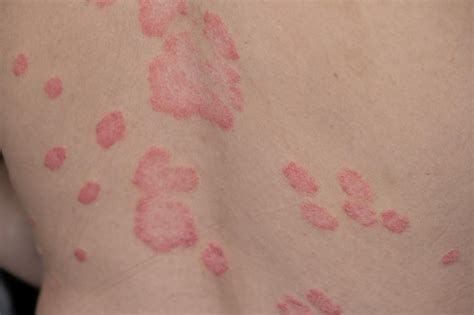 Premium Photo Psoriasis Vulgaris Skin Patches Are Typically Red Itchy