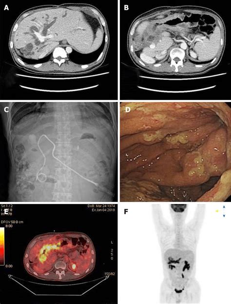 Imaging Of Admission State A And B Abdominopelvic Computed Tomography