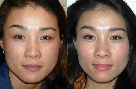 Photofacial Southern Cosmetic Laser Charleston Botox Massage