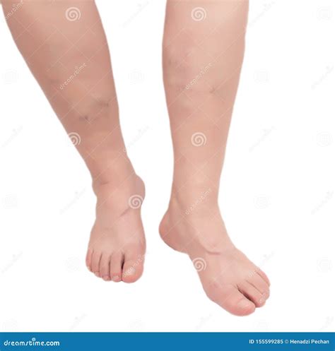Varicose Veins In An Elderly Woman S Legs On A White Background