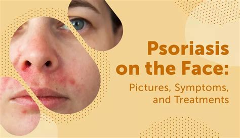 Psoriasis On The Face Pictures Symptoms And Treatments Mypsoriasisteam