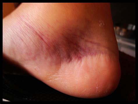 Bone Bruise Ball Of Foot