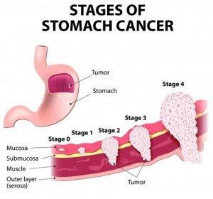 In other cases, stomach cancer patients may mistake their. Stomach Cancer (Gastric Adenocarcinoma) Symptoms, Causes ...