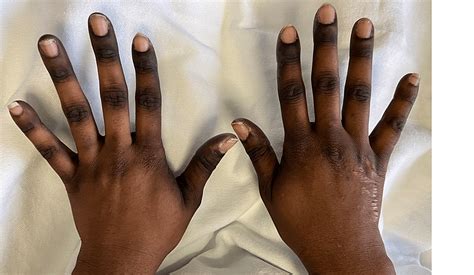 Cureus Hand Foot Syndrome Presentation Post Capecitabine Treatment In