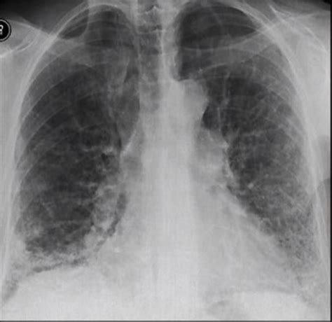 Signs And Findings In Interstitial Disease Lungs