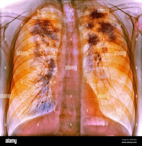 Sarkoidose Frontale farbige Röntgenaufnahme der Lunge eines 52 Jahre