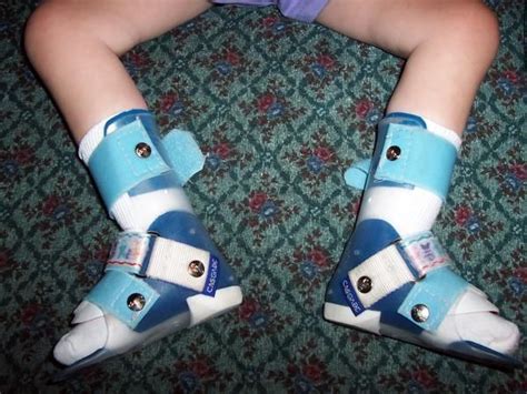 Afos Ankle Foot Orthoses Leg Braces Pinterest Braces Ankle