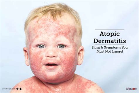 Atopic Dermatitis Signs Symptoms You Must Not Ignore By Dr
