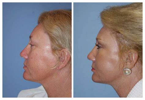 Mid Facelift Naples Fl Mini And Weekend Facelift Near Me Fort Myers