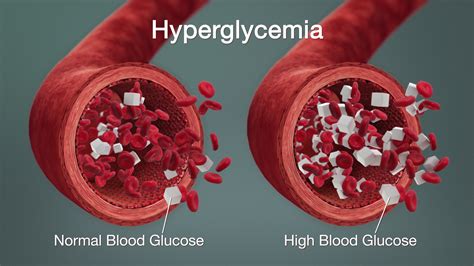 What Is Hyperglycemia Desi Khaabri