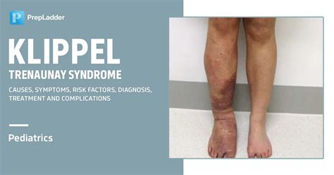 Klippel Trenaunay Syndrome Causes Symptoms Risk Factors Diagnosis
