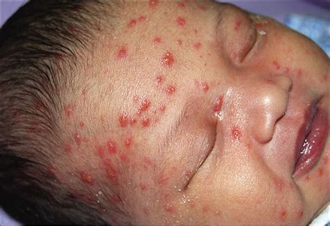 Pustules Medical Pictures Info Health Definitions Photos