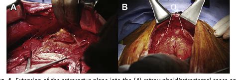 Figure 4 From Open Ventral Hernia Repair With Component Separation