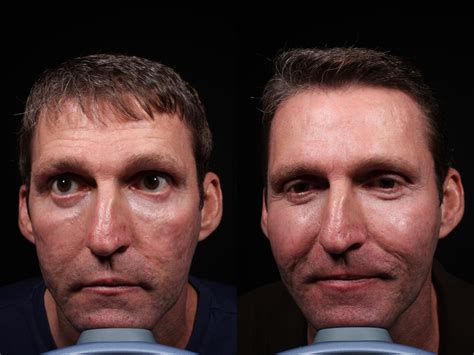 Facial Rejuvenation For Men In Vero Beach