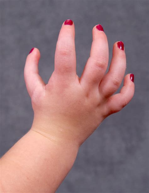 5 Finger Hand Follow Up Congenital Hand And Arm Differences
