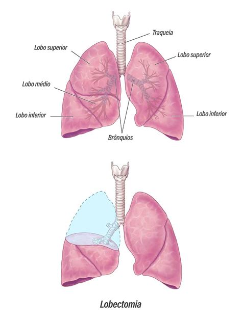 Lobectomia Pulmonar Cirurgia Torácica Do Vale