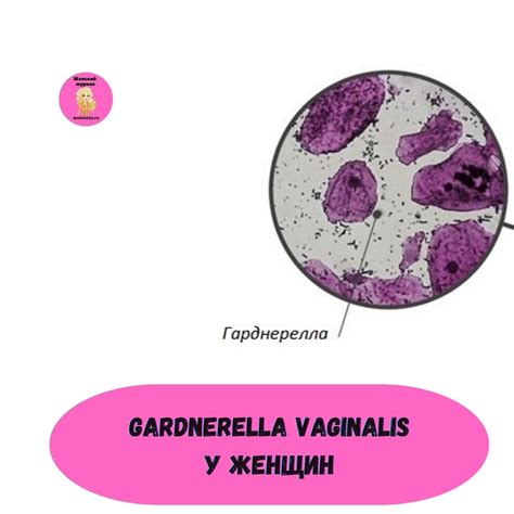 Gardnerella Vaginalis у женщин причины симптомы и лечение