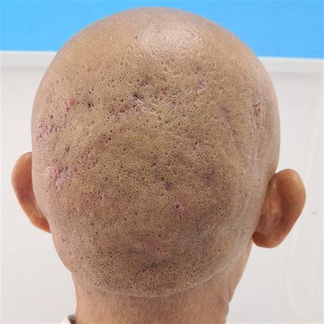 Clinical Images Scattered Pustules Crusty And Patchy Hair Loss And