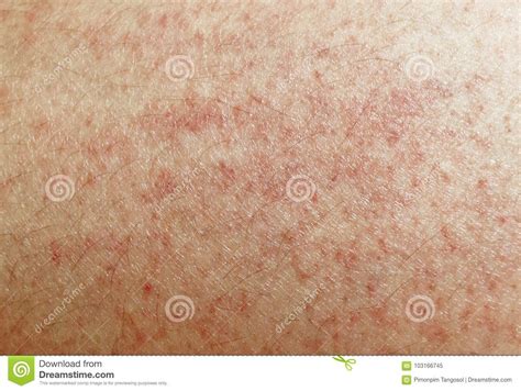 Rash On Sensitive Skin Stock Image Image Of Freckle 103166745