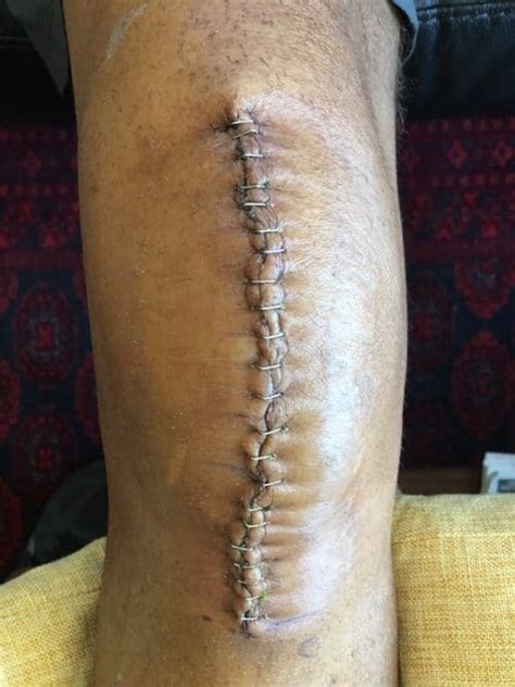 See what real incisions and scars look like throughout the healing process. 1 Year After Knee Replacement Surgery | 12 Months Of Healing