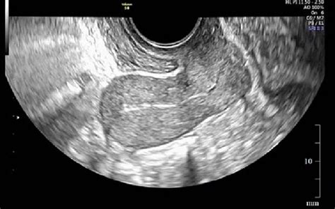 Sagittal Ultrasound Image Of The Uterus On The Th Postpartum Day Download Scientific