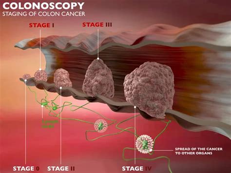 Colon Cancer Stock Photos Royalty Free Colon Cancer Images Depositphotos
