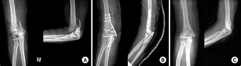 42 Year Old Female Sustained The Distal Humerus Fracture A