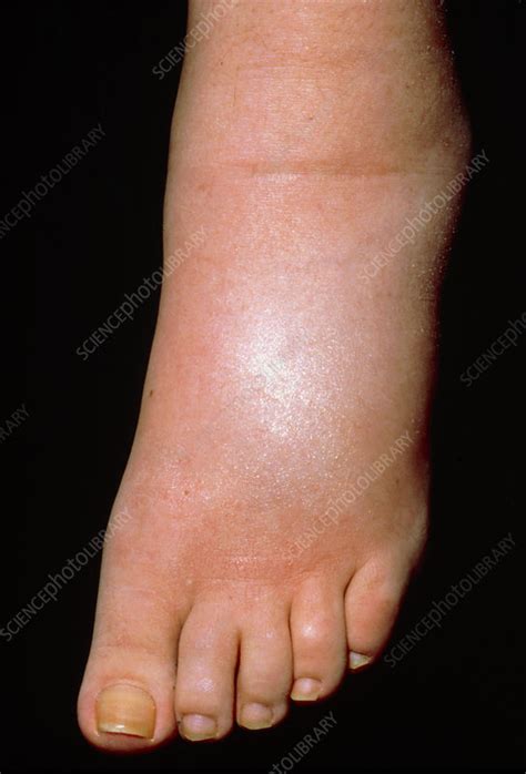 A Swollen Foot In A Case Of Pitting Oedema Stock Image M2300016