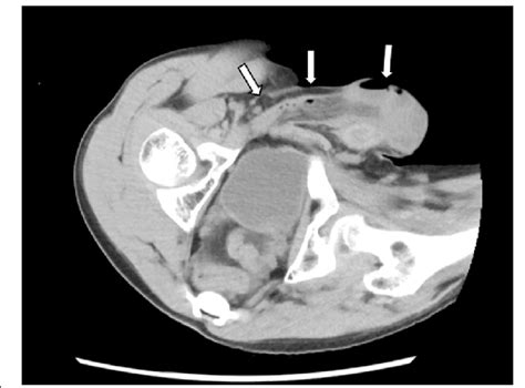 Computed Tomography Showed An Indirect Inguinal Hernia On The Right