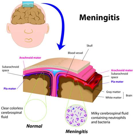 Bacterial Meningitis Treatment How Long