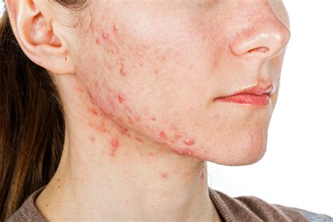 First Ever Nice Acne Guideline Recommends Mental Health Support Pulse