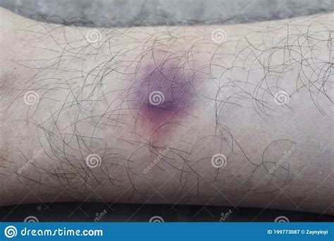Bruise In Leg Of Asian Burmese Male Patient Stock Image Image Of
