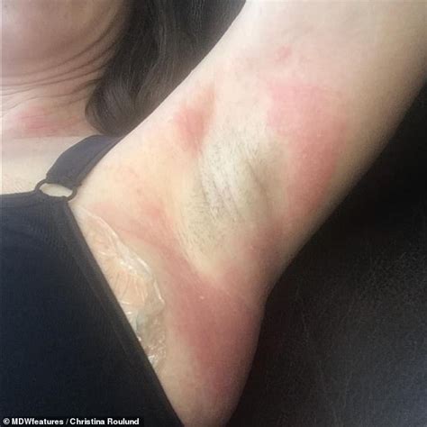 Mother Who Baffled Doctors With Mystery Rashes And Blurry Vision Blames