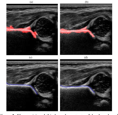 Figure 3 From Toward Automatic Diagnosis Of Hip Dysplasia From 2d Ultrasound Semantic Scholar