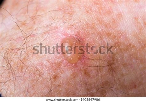 Raised Blister Caused By Cryotherapy Treat Stock Photo 1405647986