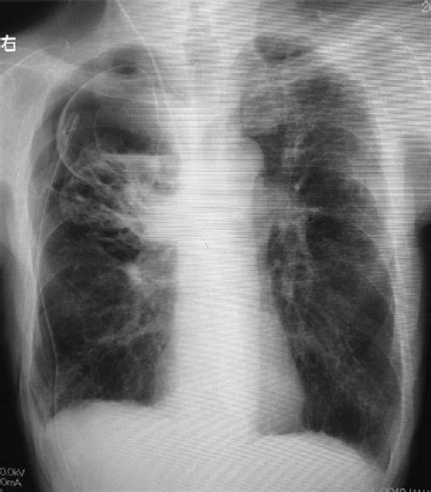 Chest Radiography After Chest Drainage Shows A Bulla And Intra Bulla