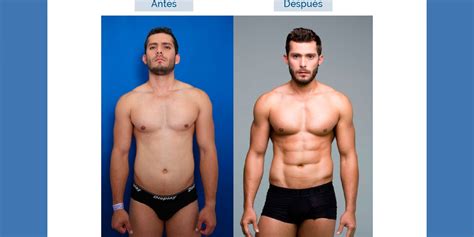 Lipo hd é uma técnica nova que esculpe as regiões da gordura, salientando a musculatura e definindo lugares estratégicos. Cirugía 'Lipo Hi Def', cuerpos en alta definición ...