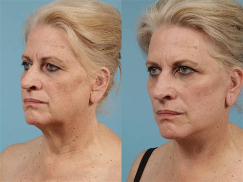 Neck Lift Before And After Pictures Case 154 Chicago Il Tlkm