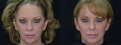 JuvÉderm Voluma Xc Before And After Pictures Case 51 Dallas Tx