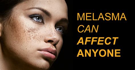 How To Cure Melasma From The Inside Wikisuggest