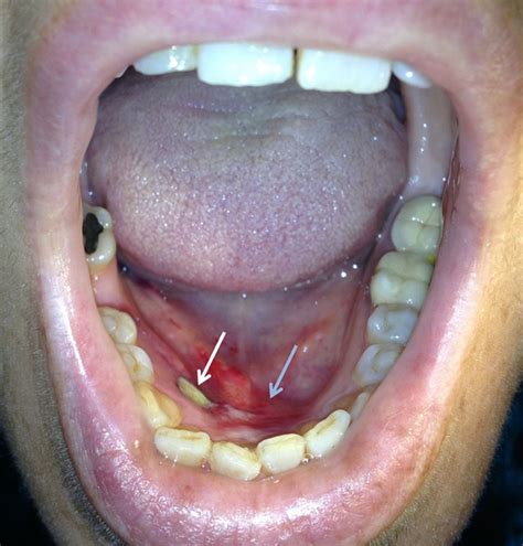 White Spot On Floor Of Mouth Under Tongue Viewfloor Co