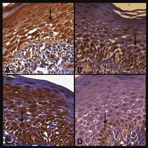 Expression Of P16 Bub3 Sox4 And Ki67 In Clp Case No 12 A P16