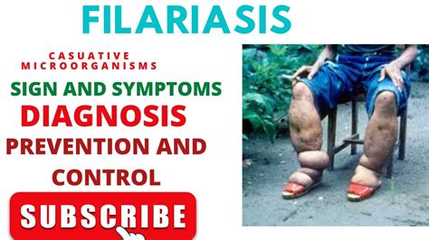 Filariasis Sign And Symptoms Diagnosis Prevention And Control
