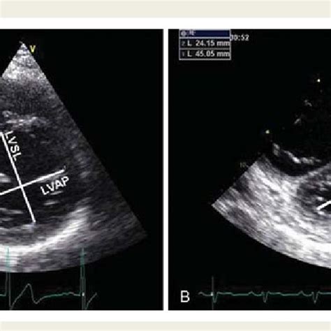 Normal Respiratory Variations Of The Tricuspid Inflow Velocities