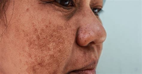 Light Discoloration On Face