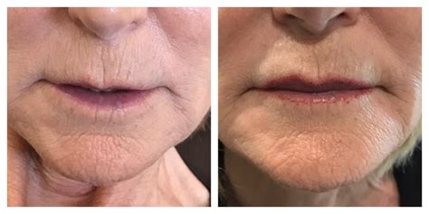 Mono Thread Lifts Non Surgical Alternative To Cosmetic Lift