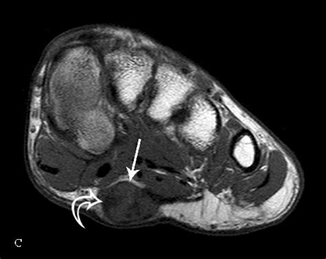 This article reviews the use of magnetic resonance imaging (mri) in the evaluation of the foot, including a discussion of bone and cartilage abnormalities Ledderhose disease - Physiopedia