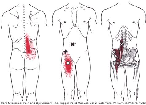Therefore a paraspinal muscle strain is when you pull the muscles in your back around your spine. Psoas Syndrome - Overlooked Cause Of Back, Hip & Groin Pain | Health | Trigger points, Referred ...