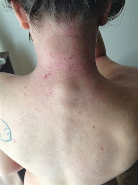 It is not that uncommon for them to stick out a bit. Scratching the Surface of Topical Steroid Withdrawal ...